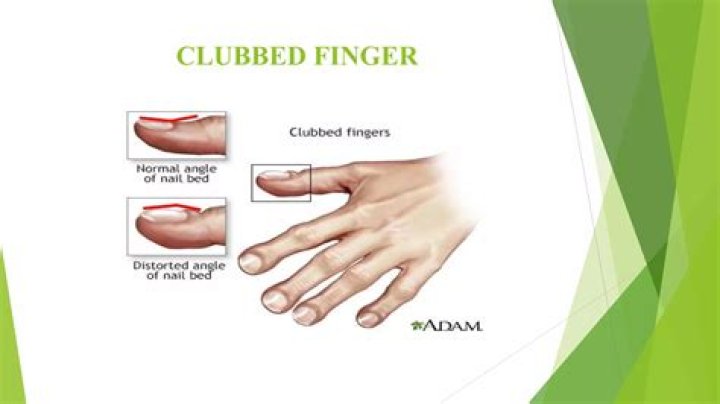 Are clubbed thumbs bad?