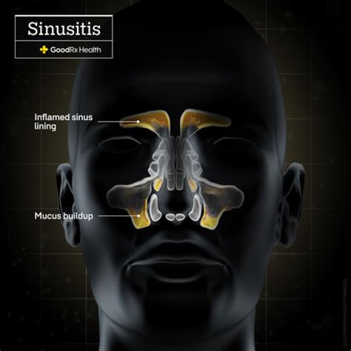 Can sinus create dizziness?