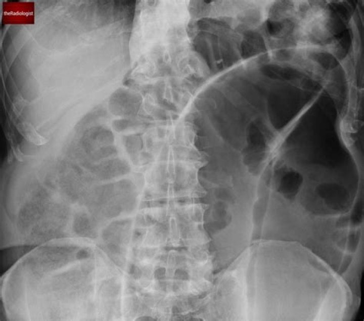 Can you see volvulus on x ray?