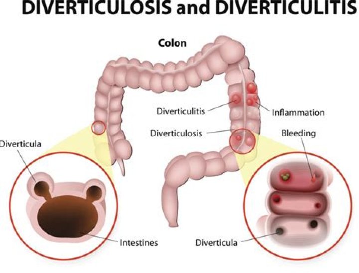 Does diverticulosis cause cancer?