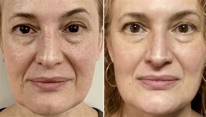 Does freckles go away?