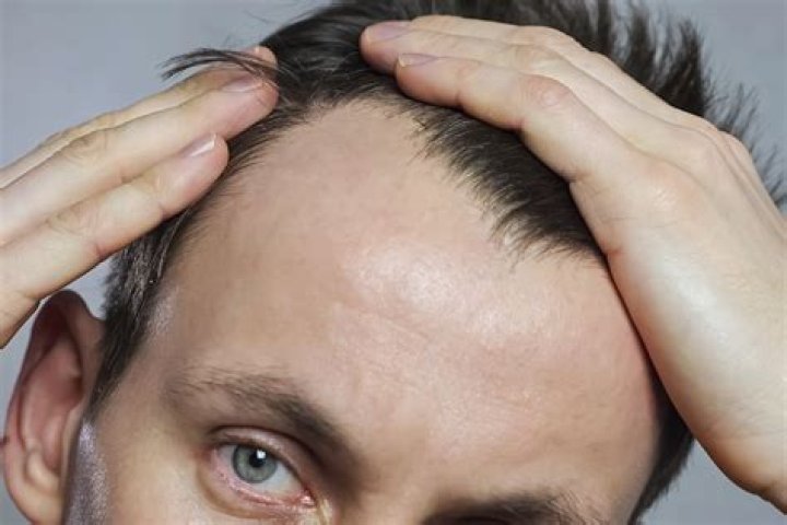 Has a receding hairline?