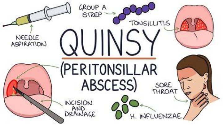 How do you get quinsy infection?