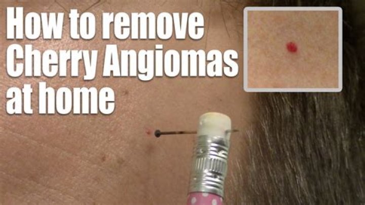 How to remove angiomas at home?