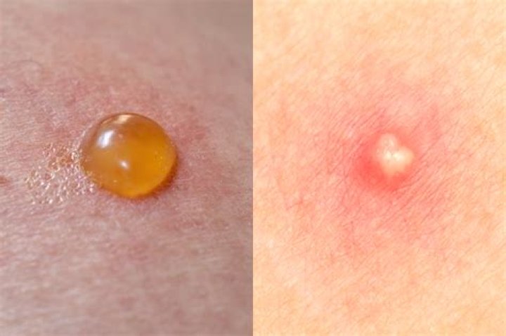 In an ant bite?