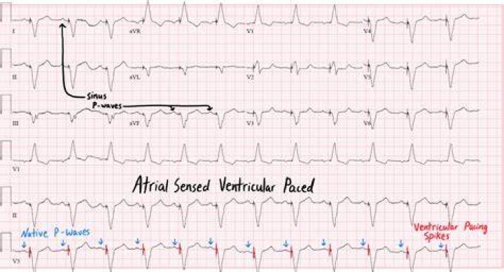 Should atrial and ventricular rates be the same?