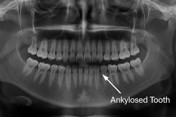 What do you mean by ankylosed tooth?