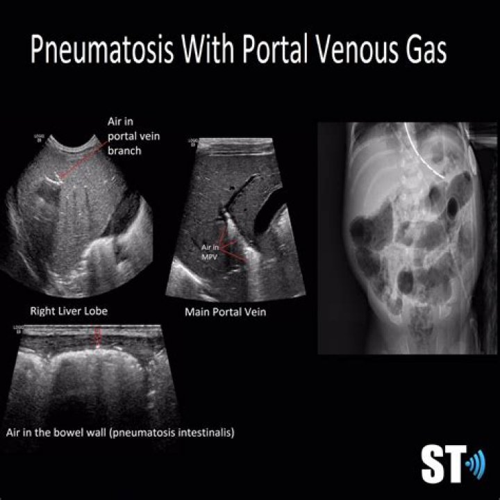 What does pneumatosis mean?