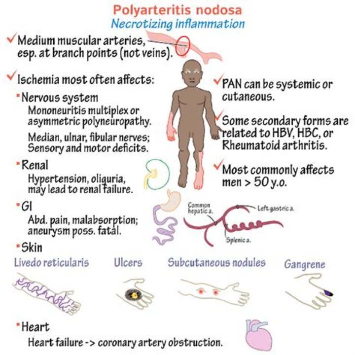 What does polyarteritis mean?