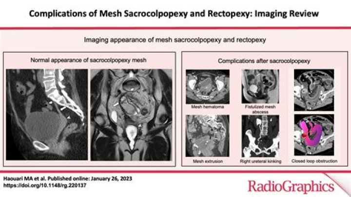 What does rectopexy mean?