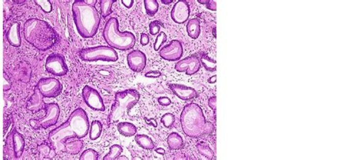 What is foveolar hyperplasia?