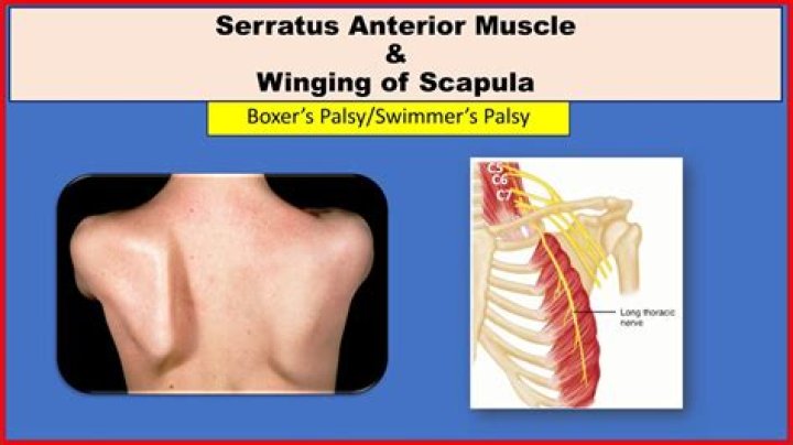 What nerve causes winged scapula?