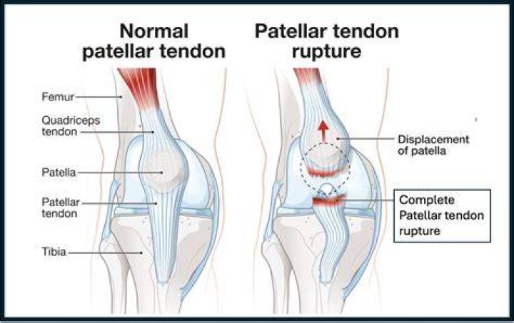 Whats behind the patella?