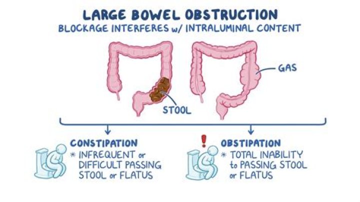Where does an ileus occur?