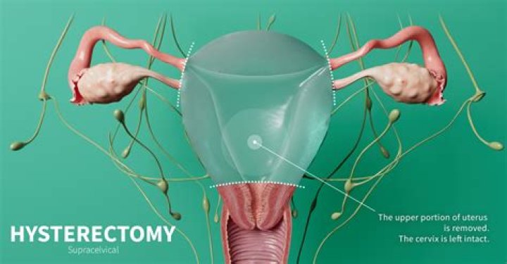 Where does ejaculate go after hysterectomy?