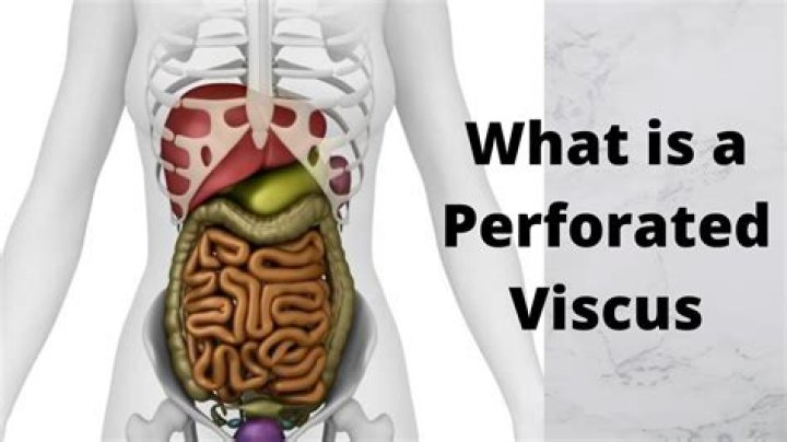 Where is a perforated viscus?