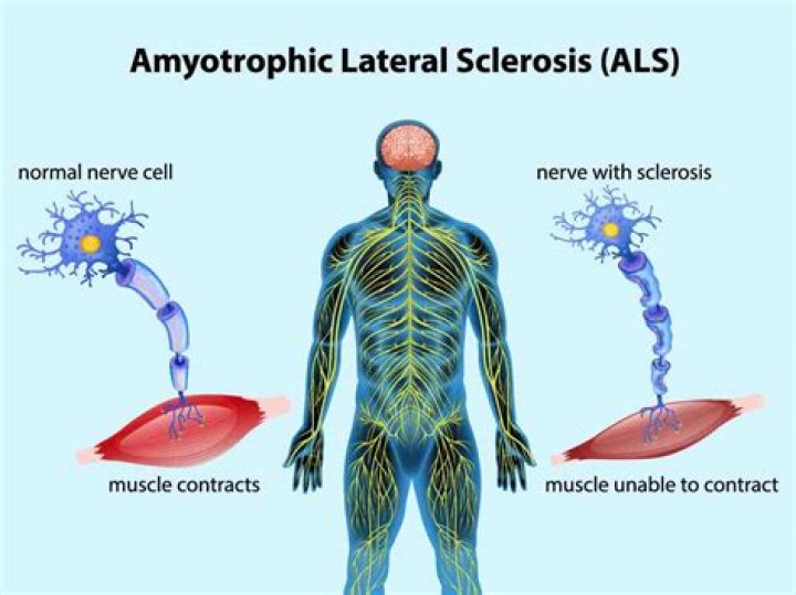Where was amyotrophic lateral sclerosis discovered?