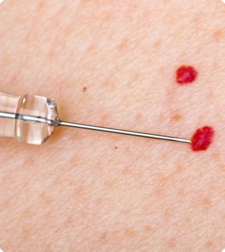 Will cherry angioma go away?